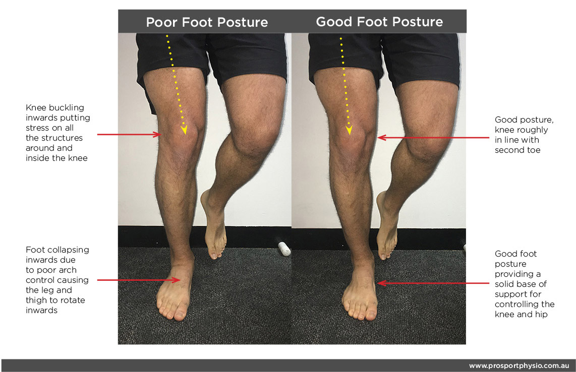 Foot posture and knee pain