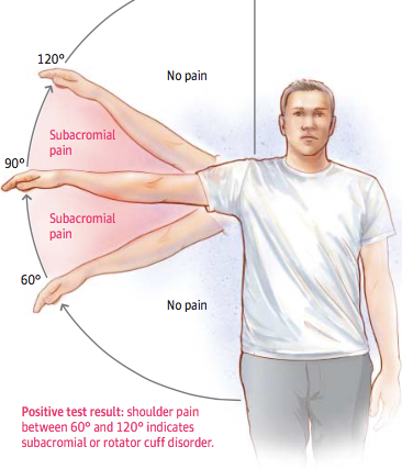 shoulder bursitis
