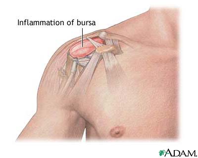 shoulder bursitis